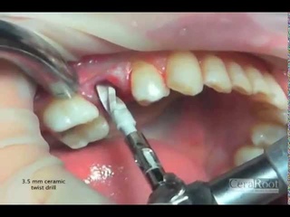 Immediate zirconia implant CeraRoot 14 in a lower premolar