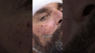 Мозок виділявся через рану в голові. Понад 5 годин під мікроскопом діставали уламки з голови бійця