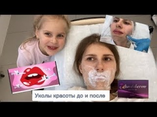 Уколы красоты до и после / Треш обзор салона красоты / Контурная пластика в 30 лет, стоит ли?