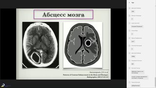 Паттерны контрастирования в МР-исследованиях головного мозга: 2 часть