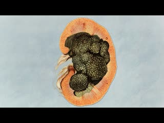 An Athlete Squatted 500 Reps In 20 Minutes. This Is What Happened To His Kidneys.