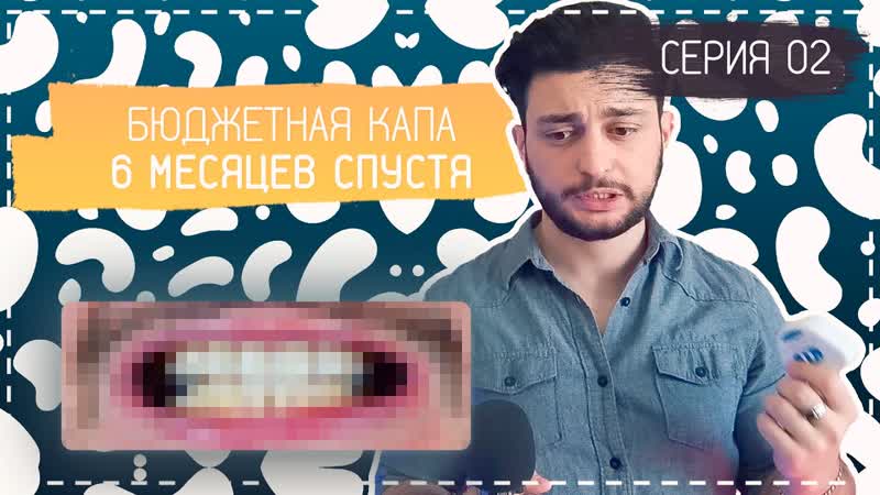 Капа для выравнивания зубов, Шесть месяцев спустя, Серия 02 ,